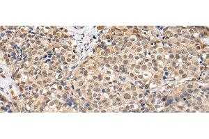 Immunohistochemistry of paraffin-embedded Human breast cancer using TBL1X Polyclonal Antibody at dilution of 1/30 (TBL1X Antikörper)