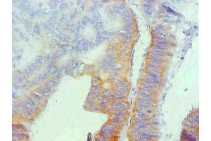Immunohistochemical of paraffin-embedded human colon cancer using ABIN7162321 at dilution of 1:200