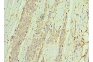 Immunohistochemistry of paraffin-embedded human colon cancer using ABIN7156926 at dilution of 1:100 (IL7R Antikörper  (AA 21-239))