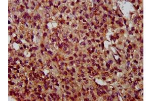 IHC image of ABIN7173123 diluted at 1:400 and staining in paraffin-embedded human glioma performed on a Leica BondTM system. (TMEM192 Antikörper  (AA 193-271))