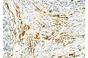 ABIN6259473 and ABIN6275568 at 1/100 staining Human pancreatic cancer and adjacent nomal tissues by IHC-P. (SH3RF3 Antikörper  (C-Term))