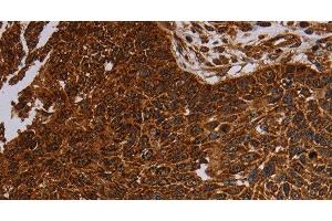 Immunohistochemistry of paraffin-embedded Human lung cancer tissue using NDUFAB1 Polyclonal Antibody at dilution 1:50 (NDUFAB1 Antikörper)