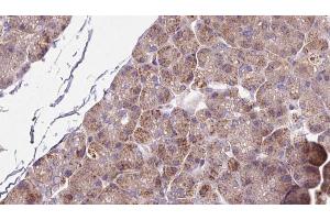 ABIN6273264 at 1/100 staining Human pancreas cancer tissue by IHC-P. (SLC39A6 Antikörper  (Internal Region))