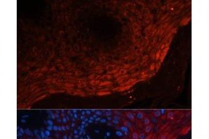 Immunofluorescence analysis of Human skin cancer using S100A8 Polyclonal Antibody at dilution of 1:100 (40x lens). (S100A8 Antikörper)