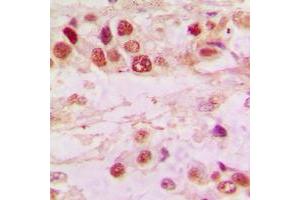 Immunohistochemical analysis of Histone Deacetylase 7 staining in human lung cancer formalin fixed paraffin embedded tissue section. (HDAC7 Antikörper  (C-Term))