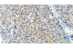 Immunohistochemistry of paraffin-embedded Human liver cancer using TPM2 Polyclonal Antibody at dilution of 1:60 (TPM2 Antikörper)