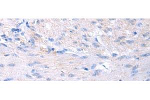 Immunohistochemistry of paraffin-embedded Human gastric cancer tissue using PROC Polyclonal Antibody at dilution of 1:80(x200) (PROC Antikörper)