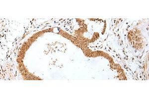 Immunohistochemistry of paraffin-embedded Human gastric cancer tissue using PEG3 Polyclonal Antibody at dilution of 1:45(x200) (PEG3 Antikörper)