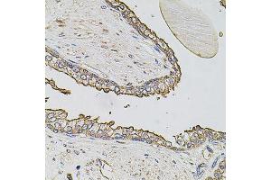 Immunohistochemistry of paraffin-embedded human prostate using ABCC3 antibody (ABIN6003581) at dilution of 1/100 (40x lens). (ABCC3 Antikörper)