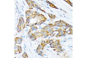 Immunohistochemistry of paraffin-embedded human esophageal cancer using STIP1 Rabbit mAb (ABIN1512566, ABIN3020619, ABIN3020620 and ABIN7101303) at dilution of 1:100 (40x lens). (STIP1 Antikörper)