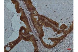 Immunohistochemistry (IHC) analysis of paraffin-embedded Human Colon Carcicnoma using STAT3 Mouse Monoclonal Antibody diluted at 1:200. (STAT3 Antikörper)