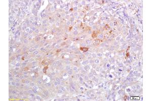 Formalin-fixed and paraffin embedded human lung carcinoma labeled with Rabbit Anti CRP Polyclonal Antibody, Unconjugated (ABIN725570) at 1:200 followed by conjugation to the secondary antibody and DAB staining (CRP Antikörper  (AA 125-224))