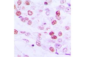 Immunohistochemical analysis of Cyclin E1 staining in human lung cancer formalin fixed paraffin embedded tissue section. (Cyclin E1 Antikörper  (Center))