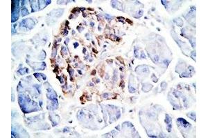 Human pancreas cancer tissue was stained by Rabbit Anti-GLP-1(7-36) -NH2 Antibody (GLP-1 Antikörper  (amidated))