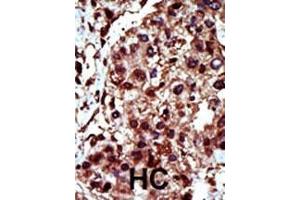 Formalin-fixed and paraffin-embedded human cancer tissue reacted with the primary antibody, which was peroxidase-conjugated to the secondary antibody, followed by AEC staining. (DGKI Antikörper  (C-Term))