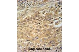 CNNM4 Antibody (Center) (ABIN651611 and ABIN2840324) immunohistochemistry analysis in formalin fixed and paraffin embedded human lung carcinoma followed by peroxidase conjugation of the secondary antibody and DAB staining. (CNNM4 Antikörper  (AA 565-593))