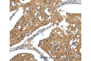 Immunohistochemistry of Human ovarian cancer using SCN5A Polyclonal Antibody at dilution of 1:30