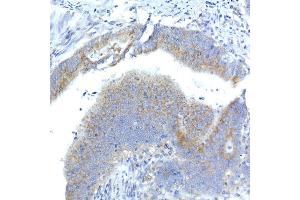 Immunohistochemistry of paraffin-embedded human colon carcinoma using Syntaxin 16 Rabbit mAb (ABIN7270681) at dilution of 1:50 (40x lens). (Syntaxin 16 Antikörper)