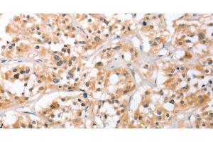Immunohistochemistry of paraffin-embedded Human thyroid cancer using HDAC8 Polyclonal Antibody at dilution of 1:40 (HDAC8 Antikörper)