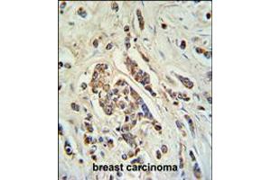 ABCC11 Antibody IHC analysis in formalin fixed and paraffin embedded breast carcinoma followed by peroxidase conjugation of the secondary antibody and DAB staining. (ABCC11 Antikörper  (N-Term))