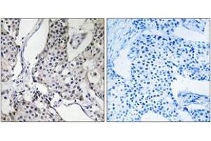Immunohistochemistry analysis of paraffin-embedded human breast carcinoma tissue, using PHLDA3 Antibody. (PHLDA3 Antikörper  (AA 21-70))