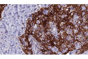ABIN6279128 at 1/100 staining Human Head and neck cancer tissue by IHC-P. (SLC4A9 Antikörper)