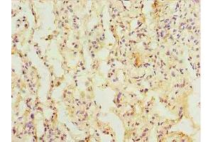 Immunohistochemistry of paraffin-embedded human lung cancer using ABIN7172386 at dilution of 1:100 (L3HYPDH Antikörper  (AA 13-312))