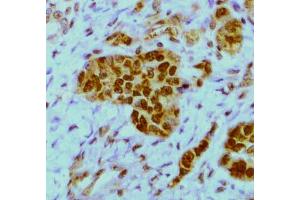 Expression of HuR in a breast tumor (FFPE section)  by staining with 19F12 monoclonal antibody (ELAVL1 Antikörper)
