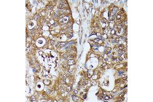 Immunohistochemistry of paraffin-embedded human colon carcinoma using MAK antibody (ABIN7268382) at dilution of 1:100 (40x lens). (MAK Antikörper  (AA 370-435))