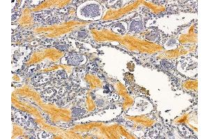 ABIN7094107 and ABIN7098151 at 1/100 staining human ovarian cancer by IHC-P.