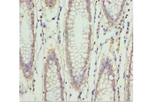 Immunohistochemistry of paraffin-embedded human colon cancer using ABIN7151997 at dilution of 1:100 (ERLIN2 Antikörper  (AA 212-339))