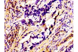 Immunohistochemistry of paraffin-embedded human pancreatic cancer using ABIN7167322 at dilution of 1:100 (RAB3A Antikörper  (AA 1-220))