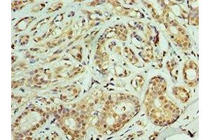 Immunohistochemistry of paraffin-embedded human breast cancer using ABIN7159904 at dilution of 1:100 (TIMM21 Antikörper  (AA 1-248))
