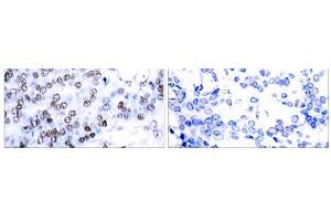 Immunohistochemical analysis of paraffin-embedded human breast carcinoma tissue using JunB (Ab-79) antibody(E021026). (JunB Antikörper)