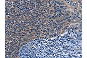 The image on the left is immunohistochemistry of paraffin-embedded Human cervical cancer tissue using ABIN7130029(KLRB1 Antibody) at dilution 1/40, on the right is treated with fusion protein. (CD161 Antikörper)