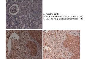 Immunohistochemistry with anti-ALG6 antibody showing ALG6 staining in the squamous epithelium of the uterine cervix as well as in inflammatory elements diffused in the stroma of human cervical cancer tissue at 20x and 40x (B & C). (ALG6 Antikörper  (N-Term))