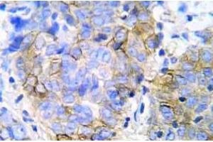 Immunohistochemistry (IHC) analyzes of JAK1 pAb in paraffin-embedded human lung adenocarcinoma tissue. (JAK1 Antikörper)