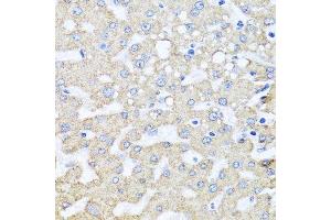 Immunohistochemistry of paraffin-embedded human liver injury using ARL6 antibody. (ARL6 Antikörper  (AA 1-186))