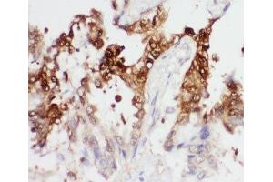IHC-P: PGK1 antibody testing of human lung cancer tissue (PGK1 Antikörper  (Middle Region))