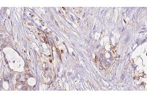 ABIN6273047 at 1/100 staining Human liver cancer tissue by IHC-P. (GSTA4 Antikörper  (N-Term))