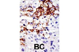 Formalin-fixed and paraffin-embedded human cancer tissue reacted with USP16 polyclonal antibody  , which was peroxidase-conjugated to the secondary antibody, followed by DAB staining . (USP16 Antikörper  (AA 132-160))