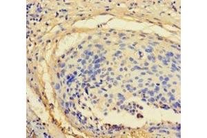 Immunohistochemistry of paraffin-embedded human cervical cancer using ABIN7176122 at dilution of 1:100 (ZNF165 Antikörper  (AA 1-485))