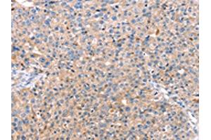 The image on the left is immunohistochemistry of paraffin-embedded Human breast cancer tissue using ABIN7128752(CAPN7 Antibody) at dilution 1/20, on the right is treated with fusion protein. (Calpain 7 Antikörper)