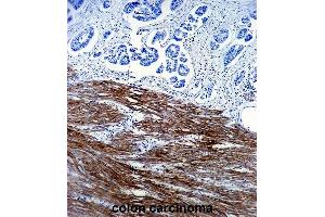 ACTA1 Antibody (ABIN1536597 and ABIN2843809) immunohistochemistry analysis in formalin fixed and paraffin embedded human colon carcinoma followed by peroxidase conjμgation of the secondary antibody and DAB staining. (Actin Antikörper)