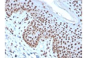 Formalin-fixed, paraffin-embedded human Basal Cell Carcinoma stained with Histone H1 Mouse Recombinant Monoclonal Antibody (rAE-4).