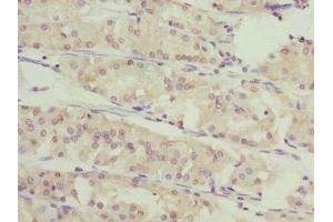 Immunohistochemistry of paraffin-embedded human gastric cancer using ABIN7166588 at dilution of 1:100 (SLC46A1 Antikörper  (AA 1-130))