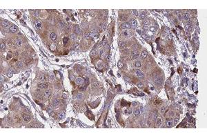 ABIN6276648 at 1/100 staining Human liver cancer tissue by IHC-P.
