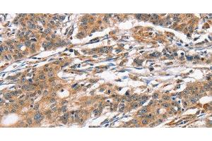 Immunohistochemistry of paraffin-embedded Human gasrtic cancer tissue using CAMK4 Polyclonal Antibody at dilution 1:40 (CAMK4 Antikörper)