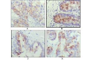 Immunohistochemical analysis of paraffin-embedded human lung cancer (A), recturn(B), prostate (C), colon cancer (D) showing cytoplasmic localization using IGFBP2 antibody with DAB staining. (IGFBP2 Antikörper  (AA 180-328))