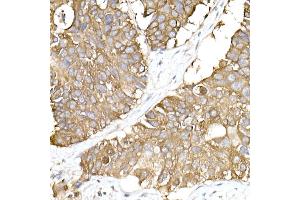 Immunohistochemistry of paraffin-embedded human lung cancer using GN Rabbit mAb  at dilution of 1:25 (40x lens).